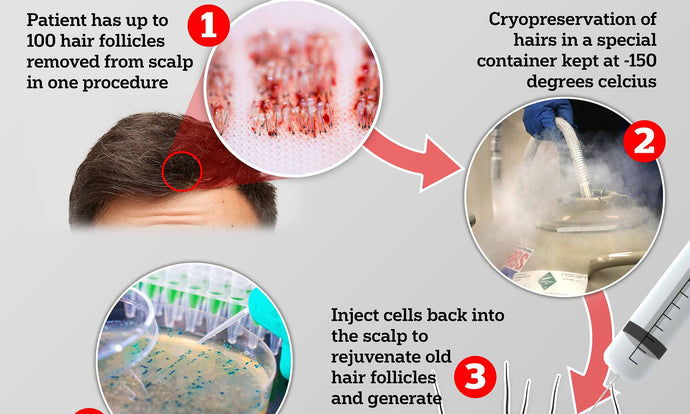 HAIRCLONE CRYOTHERAPY FOR HAIR FOLLICLES!