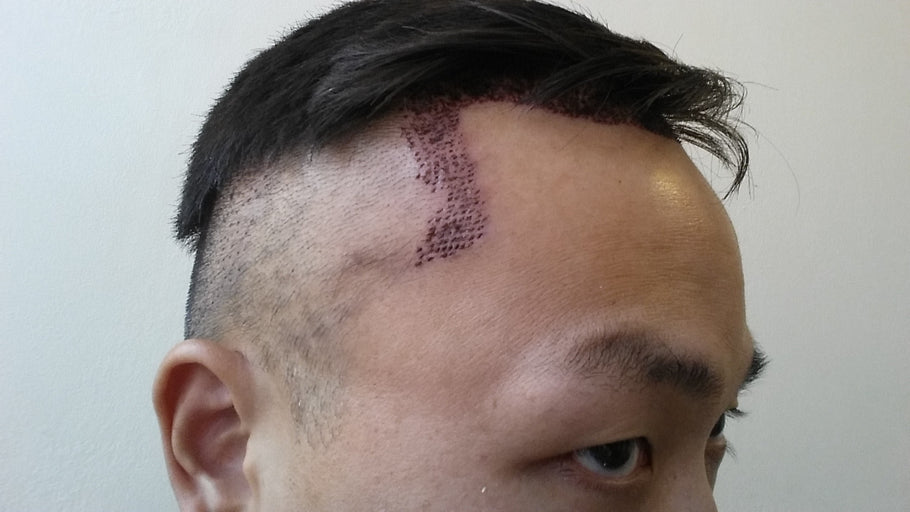 The Dark Side of Getting A Hair Transplant