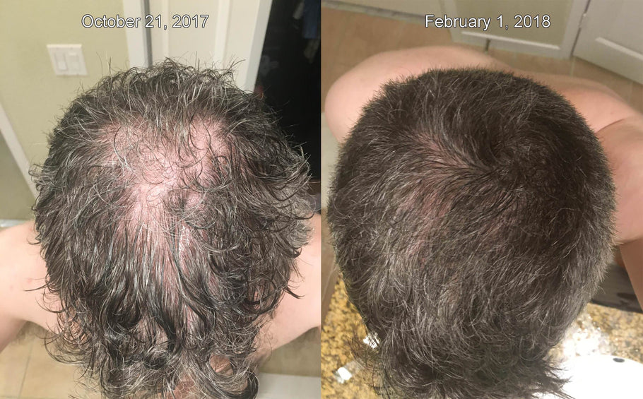 The BEST Before/After Microneedling and Derma Roller Results For Hair Loss!