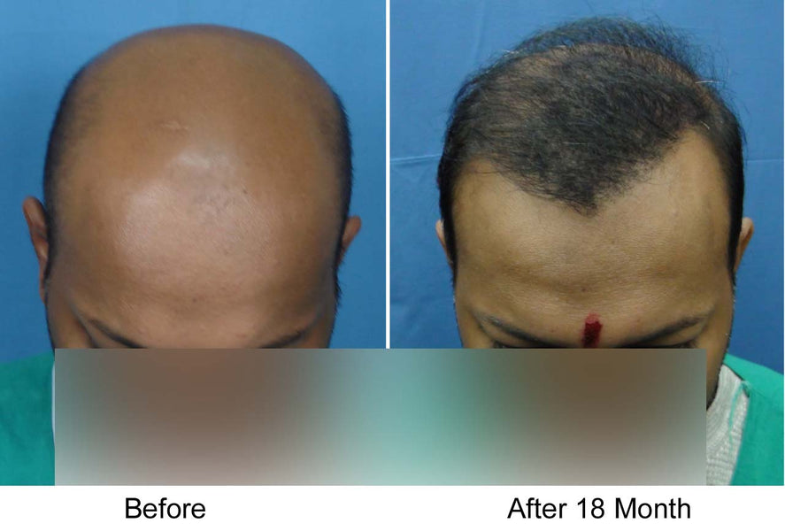 Body Hair Transplant (BHT) on the Scalp