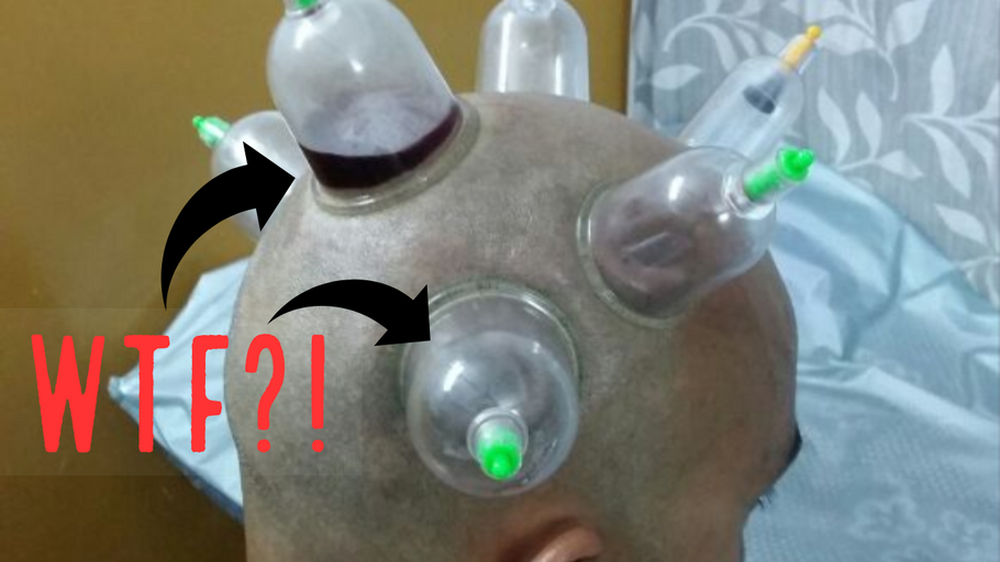 Hijama Therapy aka Cupping for Hair Growth