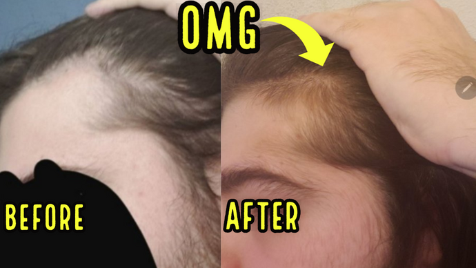 INSANE HAIR GROWTH FROM ORAL MINOXIDIL! INCREDIBLE RESULTS!
