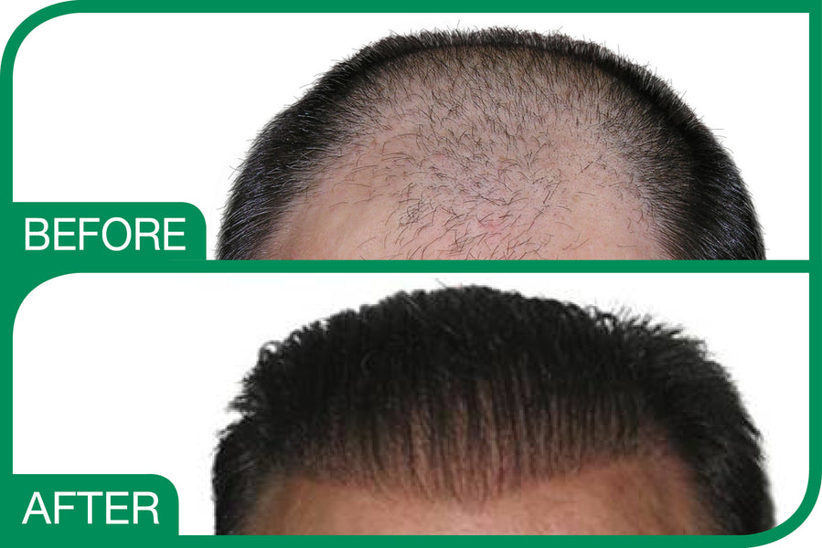 BioFiber Hair – Artificial Hair Transplant?