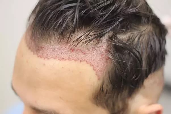6 Things NOT To Do After A Hair Transplant