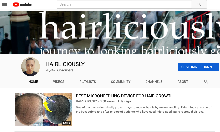 hairliciously youtube hair transplant